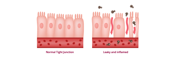 An illustration showing the difference between a normal tight junction in the gut and a leaky and inflamed junction