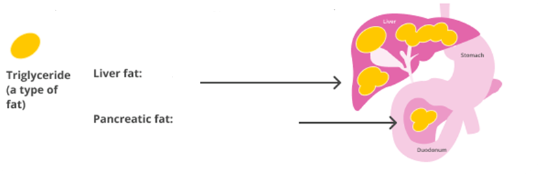 A diagram showing fatty liver and pancreas.