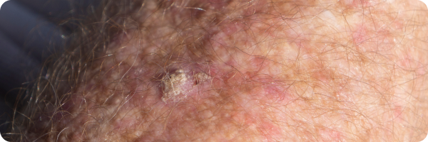 A close-up photograph of a squamous cell carcinoma which, in this case, presents as a pale, raised scab-like crust.