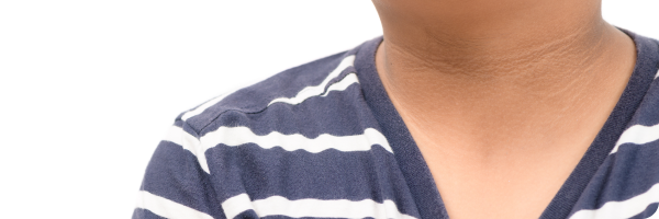 A photo of a boy's neck wearing a blue and white striped t-shirt. He has acanthosis nigricans which is characterised by darker pigmented skin
