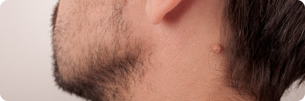 A photo of back of a man's head. He has a large mole near his hairline under his ear.