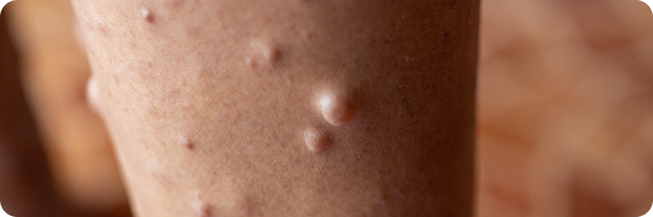 A close-up photo of an arm with several neurofibromas, all skin-coloured.