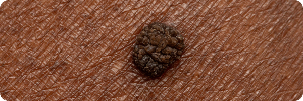 A close up photo of seborrheic keratosis and its surrounding skin.
