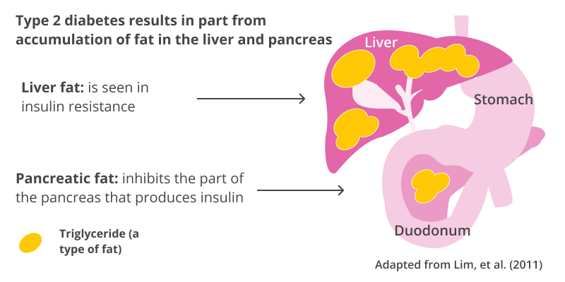 A diagram showing how type 2 diabetes results in part from accumulation of fat in the liver and pancreas.

An illustration of the liver and duodenum with deposits of triglycerides (a type of fat).

Liver fat is seen in insulin resistance.

Pancreatic fat inhibits the part of the pancreas that produces insulin.

Adapted from Lim, et al. (2011)