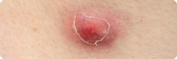 A boil or furnucle, lump under the skin.