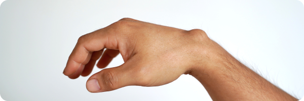 A ganglion cyst under the skin of a hand.