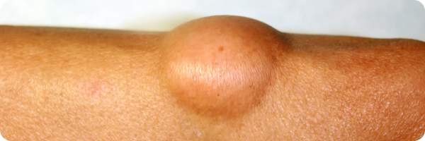 A lipoma on the elbow.