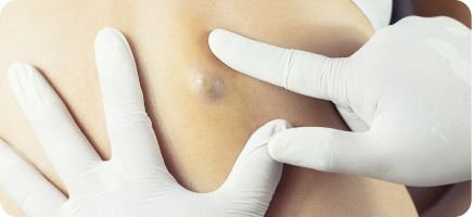 A lump under the skin.