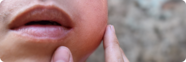 A swelling under the skin of the cheek.